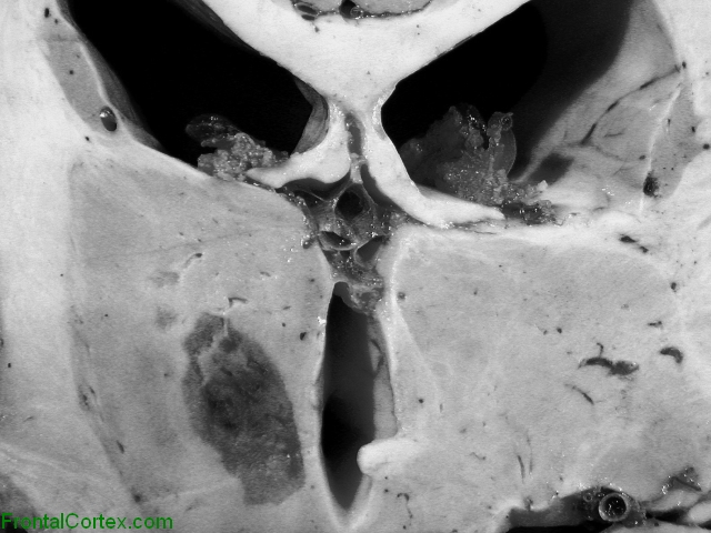 Cavitated thalamic infarct, coronal section.